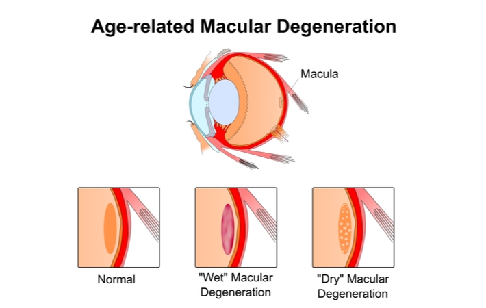 A diagram of age-related macular degeneration, highlighting what a normal eye looks like versus an eye with wet and dry macular degeneration