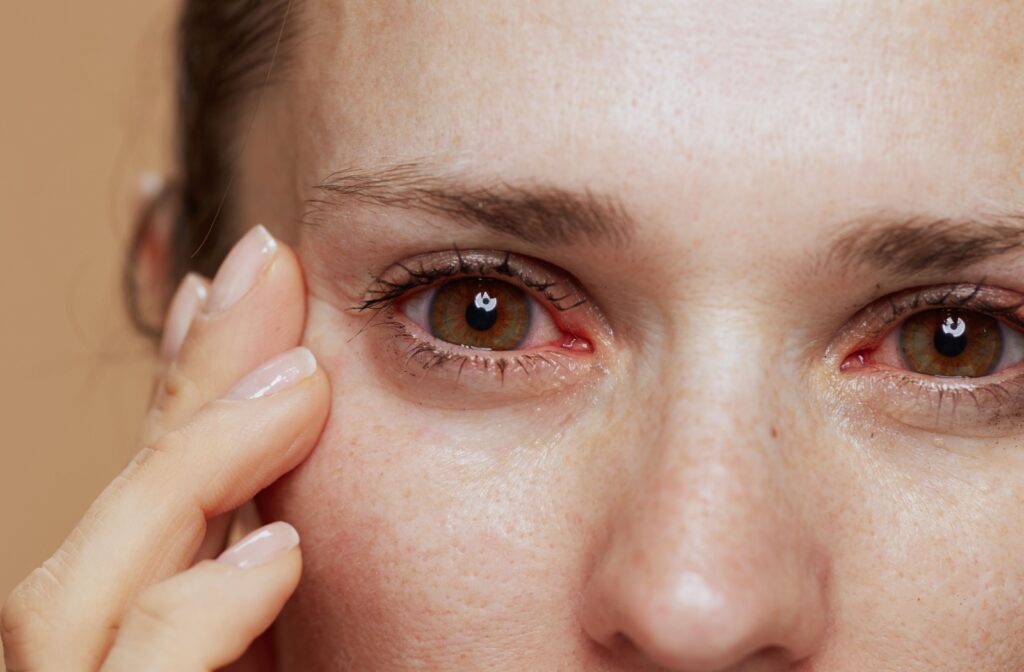 A patient's eyes are red, watery, and irritated because of chronic dryness.