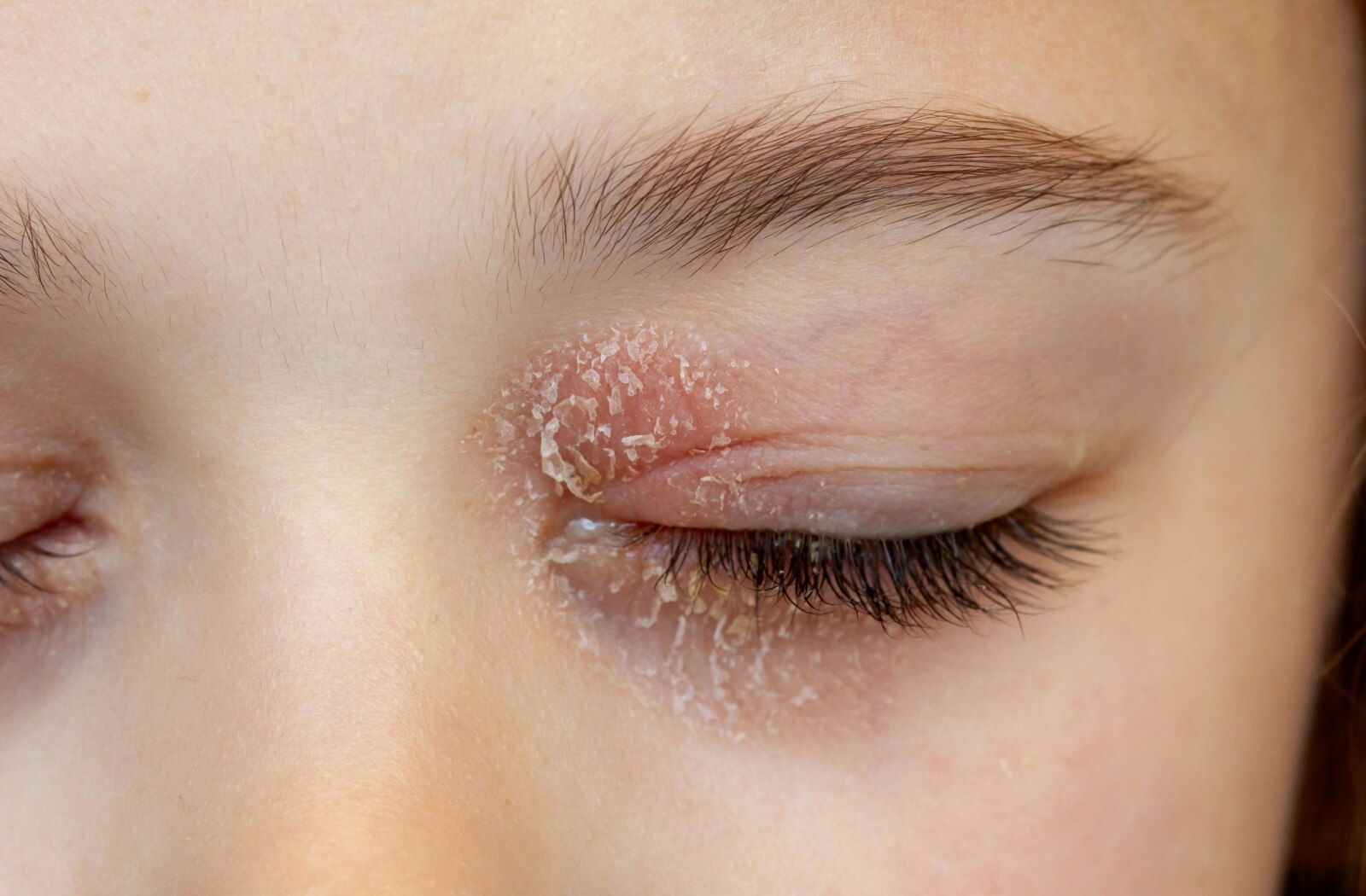 A close-up image of someone with blepharitis symptoms.