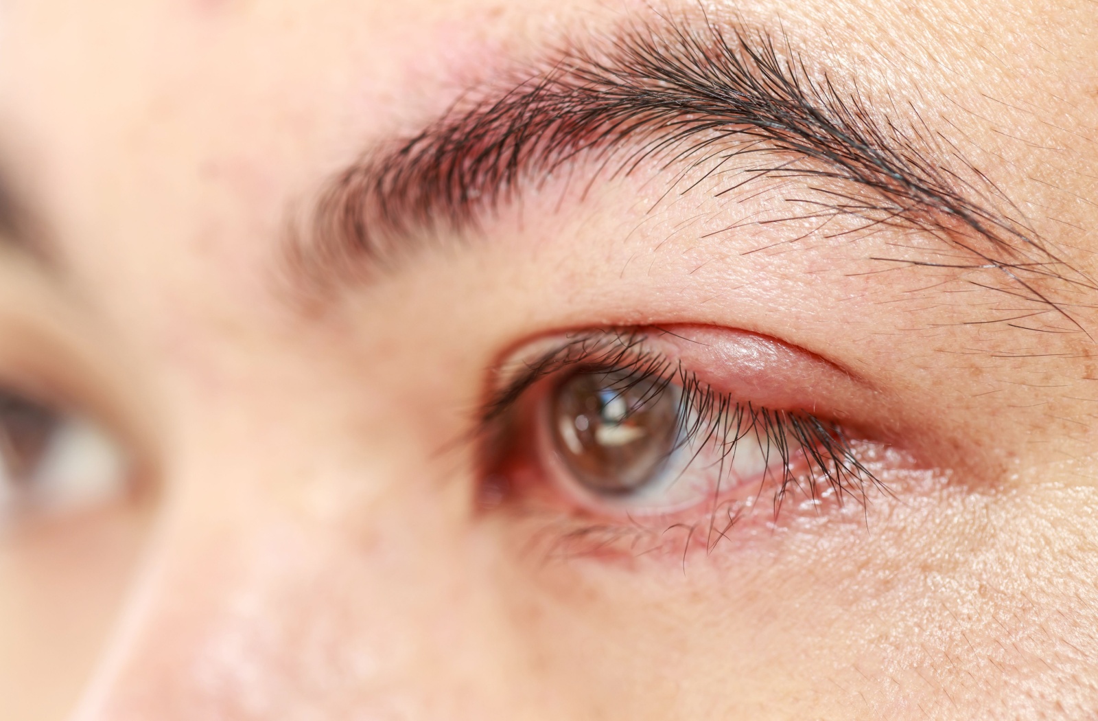Close-up of an inflamed upper eyelid with visible swelling, commonly caused by a clogged meibomian gland.