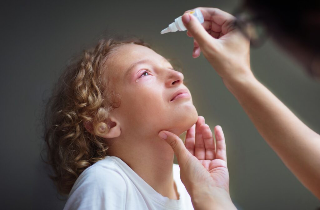A child with irritated, red eyes receiving medicated eye drops to relieve symptoms of conjunctivitis or eye irritation.
