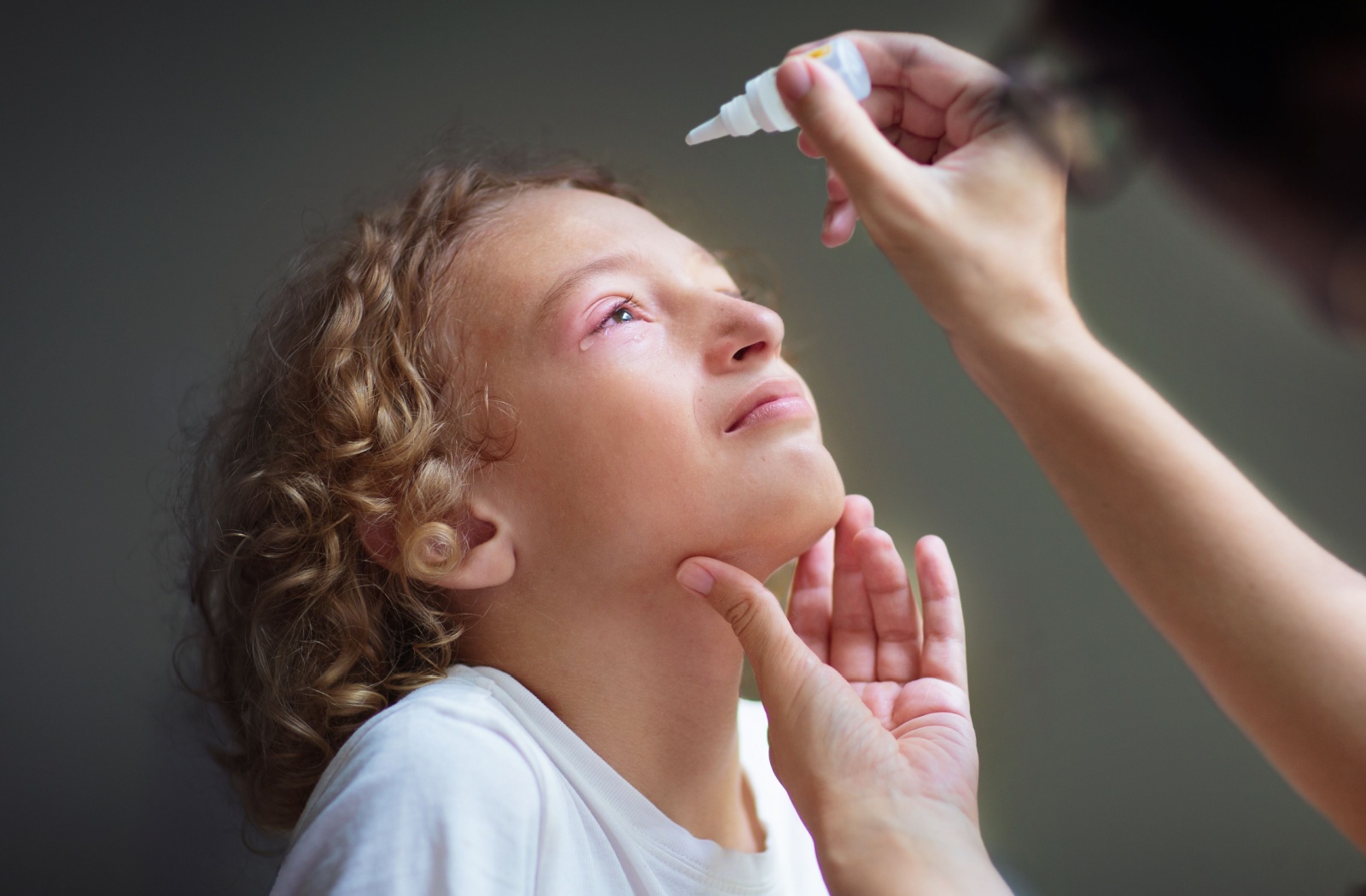 A child with irritated, red eyes receiving medicated eye drops to relieve symptoms of conjunctivitis or eye irritation.