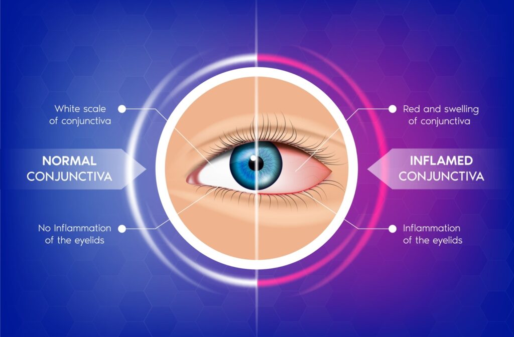 Medical illustration comparing a healthy eye to one with conjunctivitis, showing redness, swelling, and inflammation of the eyelids and conjunctiva.