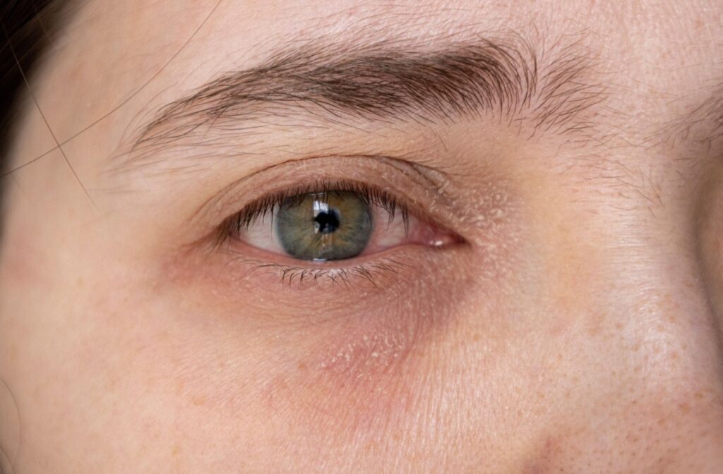 Close up of an adult who has dry eyelids