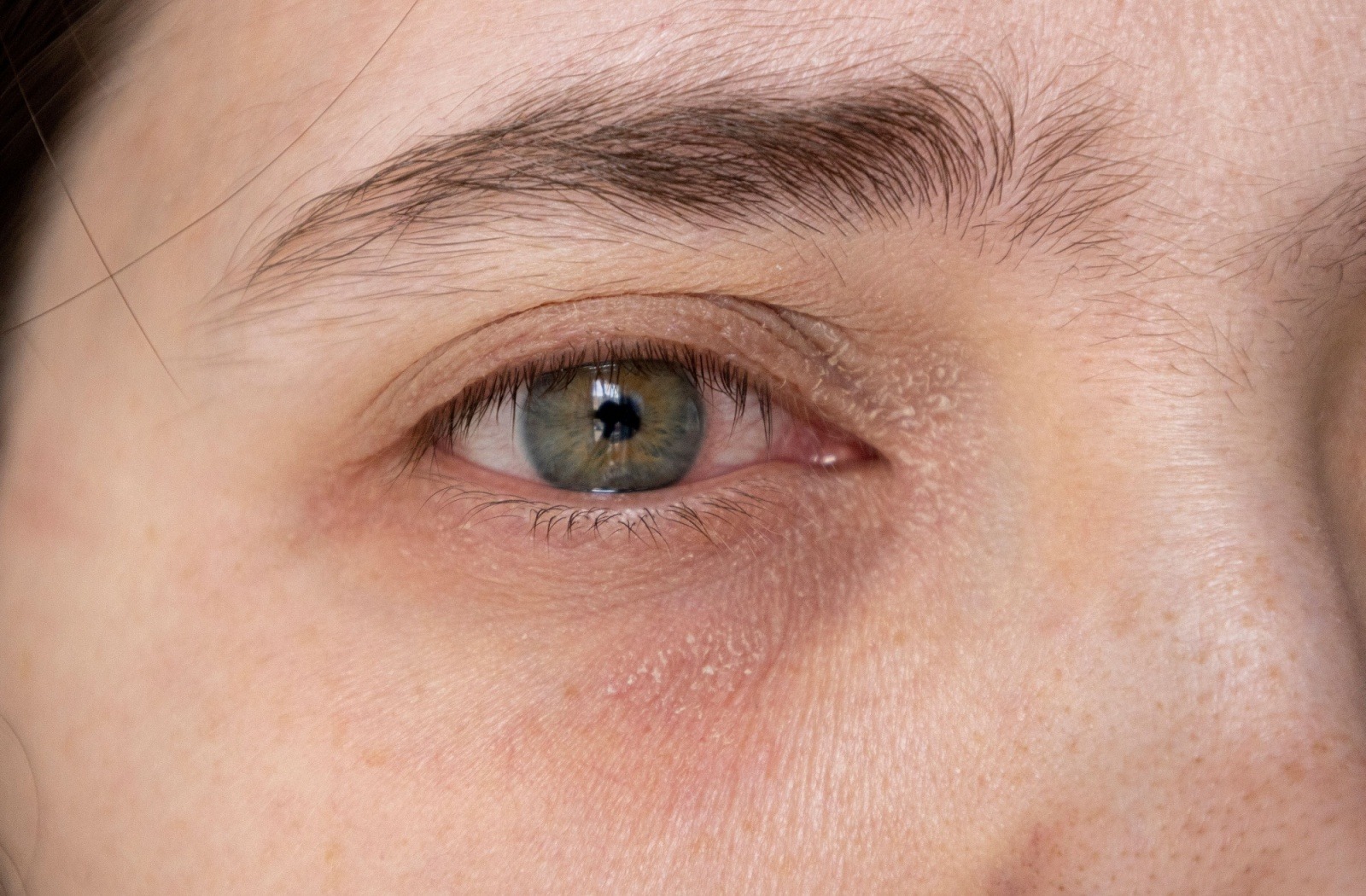 Close up of an adult who has dry eyelids